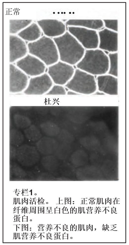 DMD诊断与管理-家庭指导第4章（Duchenne的病因是什么？）DMD, 肌营养不良，肌肉萎缩，杜氏肌营养不良至爱杜氏肌营养不良关爱中心