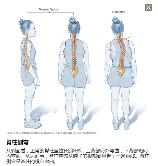 脊柱侧弯DMD, 肌营养不良，肌肉萎缩，杜氏肌营养不良至爱杜氏肌营养不良关爱中心